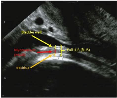 measurement of lower uterine segment thickness|lower uterine segment thickness.